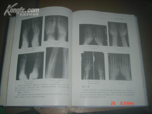 实用体质骨病学（16开精装 馆藏 有大量X光图片）