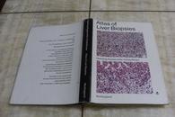 Hemming  Poulsen  &  Per  Christoffersen:Atlas  of  Liver  Biopsies（1981年1版2印  有描述有清晰书影供参考）