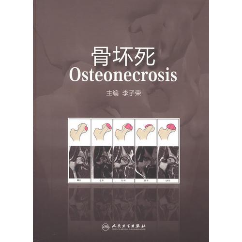 骨壞死