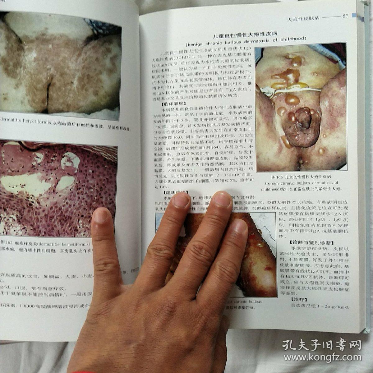 外生殖器皮肤病性病彩色图谱