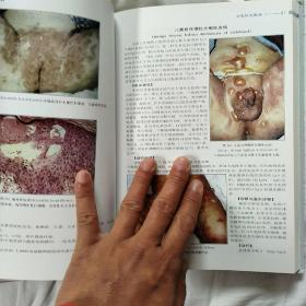 外生殖器皮肤病性病彩色图谱