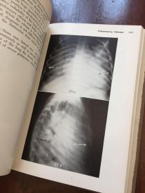 THE CHEST A HANDBOOK OF ROENTGEN DIAGNOSIS(胸部X线诊断手册)英文原版