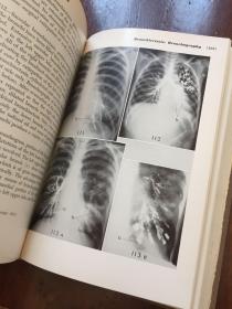 THE CHEST A HANDBOOK OF ROENTGEN DIAGNOSIS(胸部X线诊断手册)英文原版