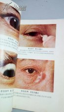173    常见眼病的防治  彩色插图   上海第二医学院附属新华医院眼科      上海市出版革命组   1970年8月一版一印