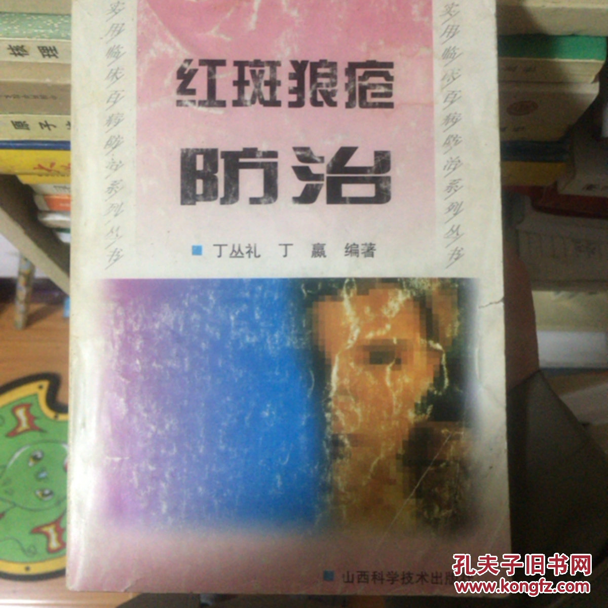 红斑狼疮防治