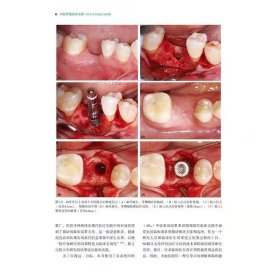 【正版现货】口腔种植临床决策 外科手术和修复方案图集
