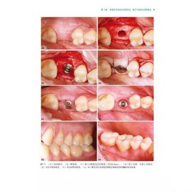 【正版现货】口腔种植临床决策 外科手术和修复方案图集