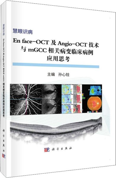 En face-OCT及Angio-OCT技术与mGCC相关病变临床病变应用思考