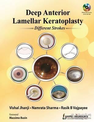 现货 Deep Anterior Lamellar Keratoplasty: Different Strokes[9789350256329]