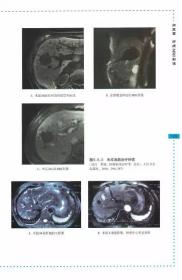 正版 肝癌诊疗影像学图谱 丁世斌 司永仁 吴威 主编 9787538193428 辽宁科学技术出版社 肿瘤学 影像医学诊断 书籍