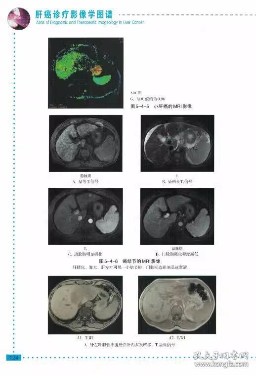 正版 肝癌诊疗影像学图谱 丁世斌 司永仁 吴威 主编 9787538193428 辽宁科学技术出版社 肿瘤学 影像医学诊断 书籍