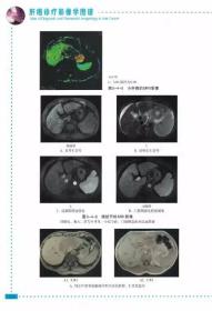 正版 肝癌诊疗影像学图谱 丁世斌 司永仁 吴威 主编 9787538193428 辽宁科学技术出版社 肿瘤学 影像医学诊断 书籍