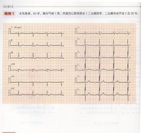 正版 心电图10日速成 第2二版 张新民 图解速成讲授书籍明明白白临床分析与诊断心电图学书籍经典图谱教学手册高手速成入门掌中宝