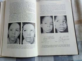 STRABISMUS A CLINICAL HANDBOOK 【斜视临床手册】24开、23.5 x  15.5 cm  、布面精装、1948年版