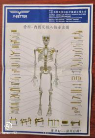 骨科内固定植入物示意图