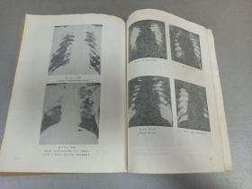 W   1976年  山西卫生出版社出版   中山医学院编写组编   《内科疾病鉴别诊断学》  一册全！！！