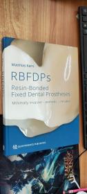 Rbfdps: Resin-Bonded Fixed Dental Prostheses: Minimally Invasive - Esthetic - Reliable树脂粘结固定义齿：微创-美观-可靠
