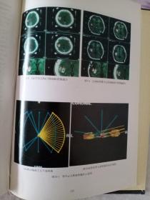 颅脑疾病X刀治疗学

有划痕