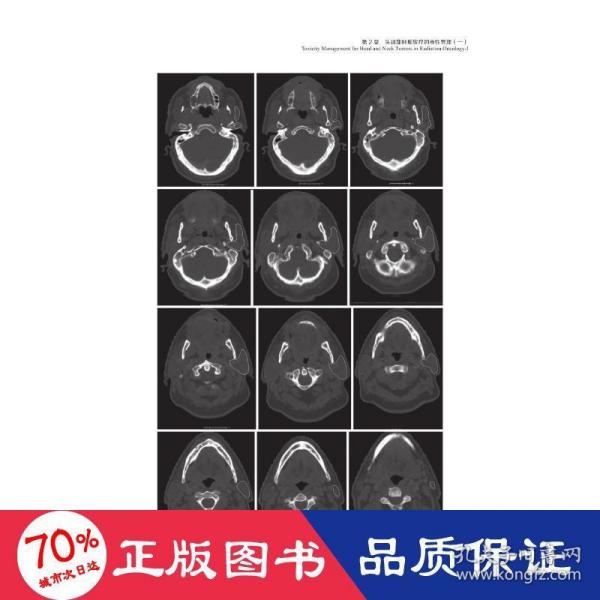 放射肿瘤学急性与晚期毒性的防治：放射肿瘤学中的毒性管理