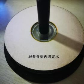 胫骨骨折内固定术VCD