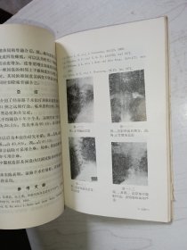颈椎病（北京医学院第三附属医院1975年版）