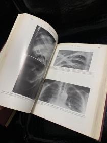 DIAGNOSIS OF DISEASES OF THE CHEST VOLUME1.2【2本合售】胸部疾病诊断