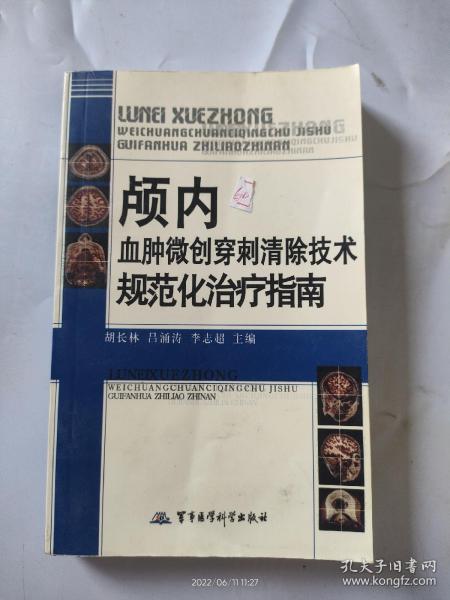 颅内血肿微创穿刺清除技术规范化治疗指南