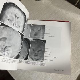Normal Neuroradiology And Atlas of the Skull, Sinuses, and Facial Bones ，正常神经放射学 和颅骨（头骨）、鼻窦和面部骨骼图谱图集，大开本