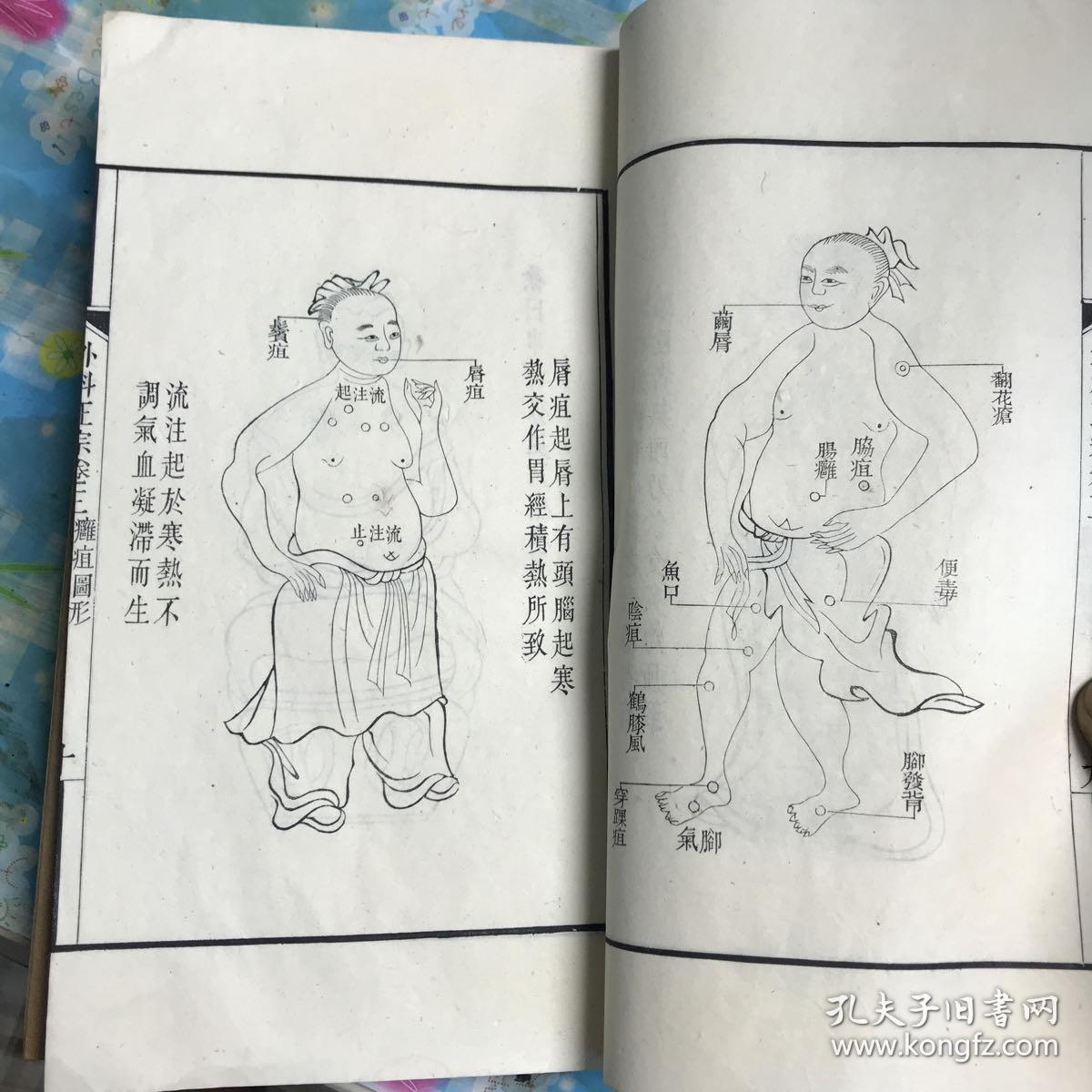 重订外科正宗 外径27x16.7cm 内府 桃花纸开化纸内径19.5x13.5cm12卷本之 初版本 品佳 存3-4卷 9-10卷 11-12卷三册