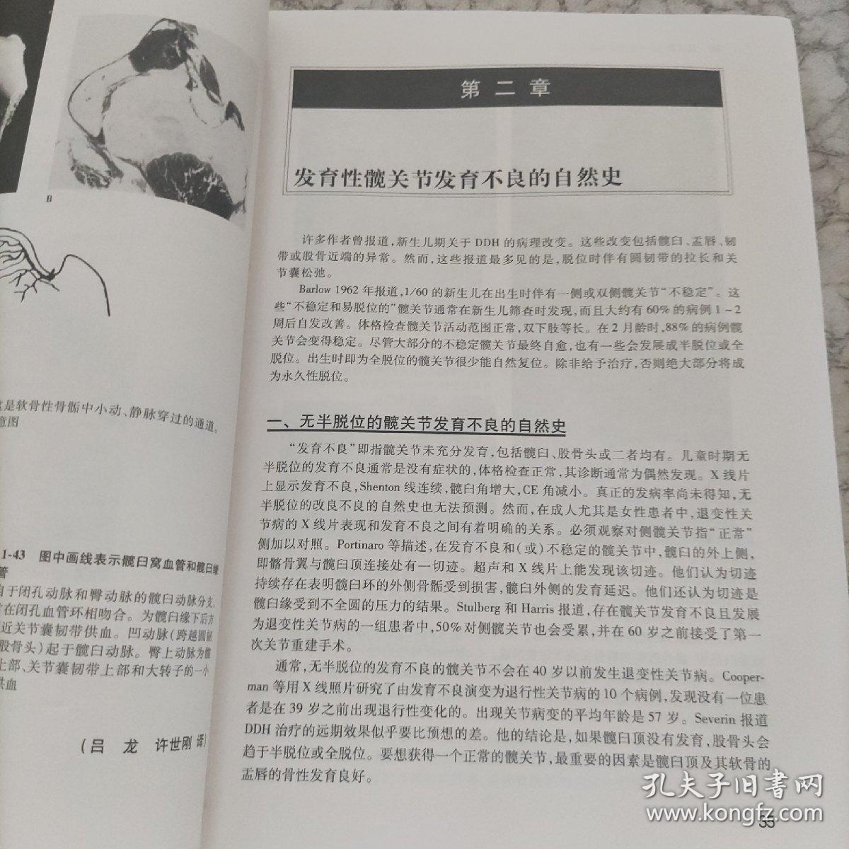 发育性髋关节发育不良  内容全新