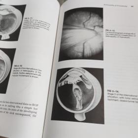 【英文医学原版著作】   treatment  of  retinopathy  of   prematurity     早产儿视网膜病变的治疗    精装   馆藏