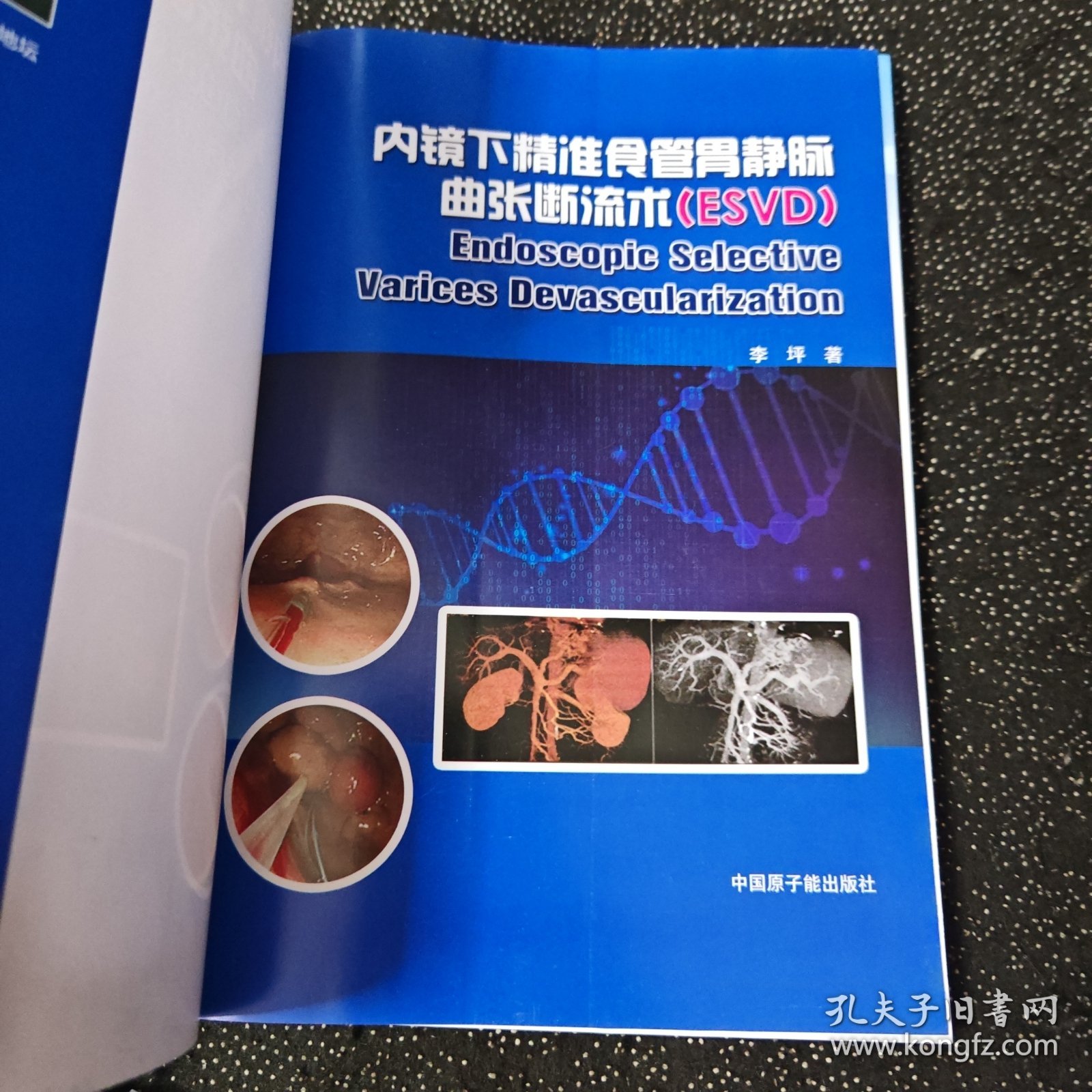内镜下精准食管胃静脉曲张断流术ESVD