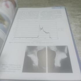 骨水泥型全髋关节置换术