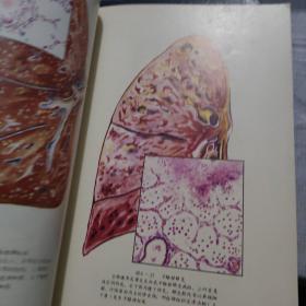 病理解剖学图谱（全书收录插图520幅) 1979年一版一印