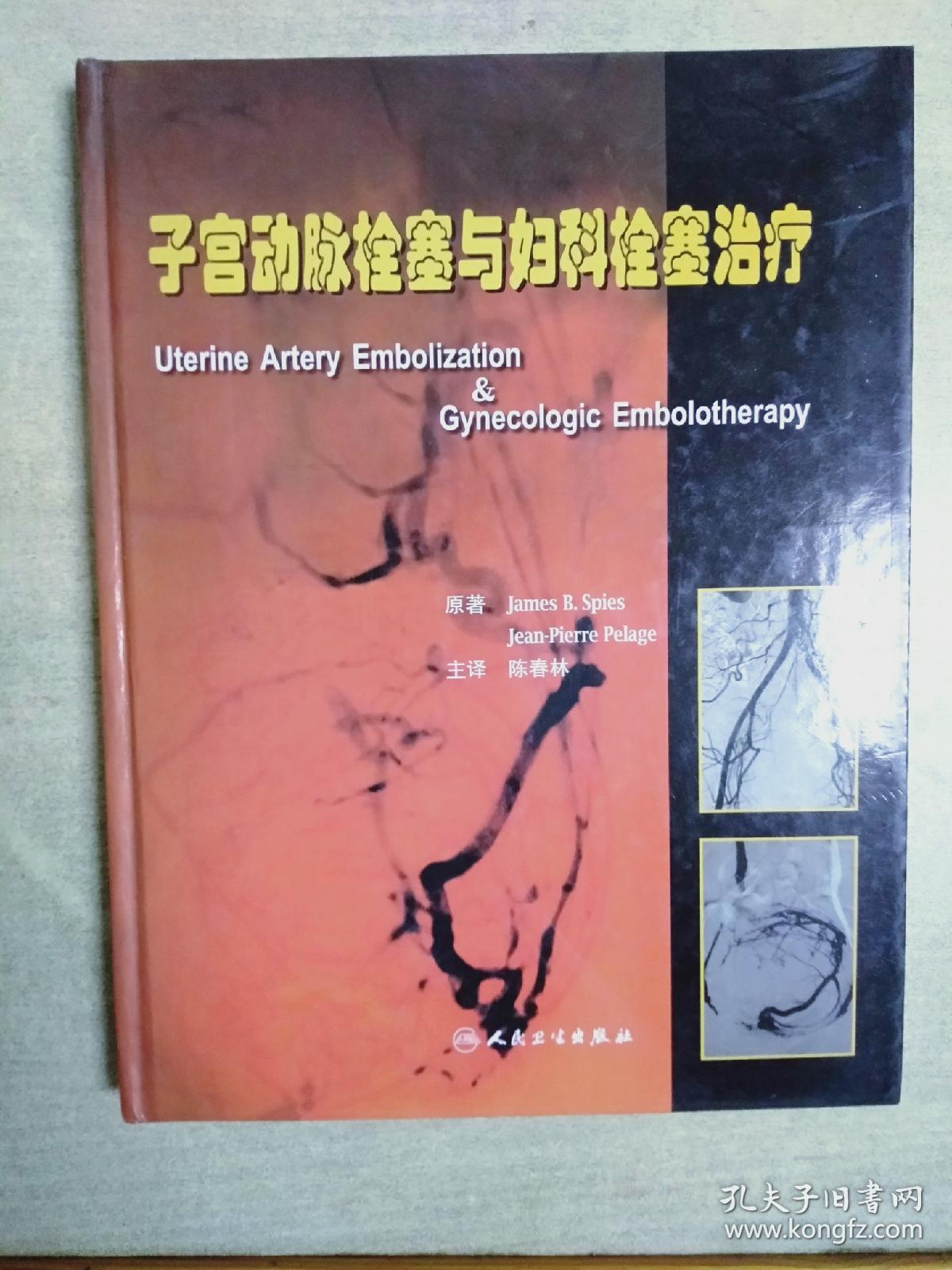 子宫动脉栓塞与妇科栓塞治疗