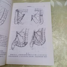 大肠癌根治术