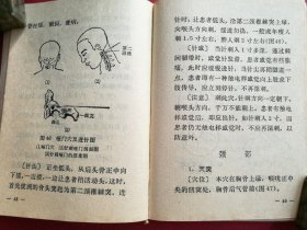 红宝书——快速针刺疗法（64开180页，红色塑料封套精装本，1969年11月人民卫生社1版1印）