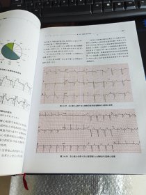 起搏心电图解析