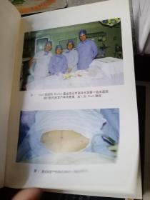 新式剖宫产术