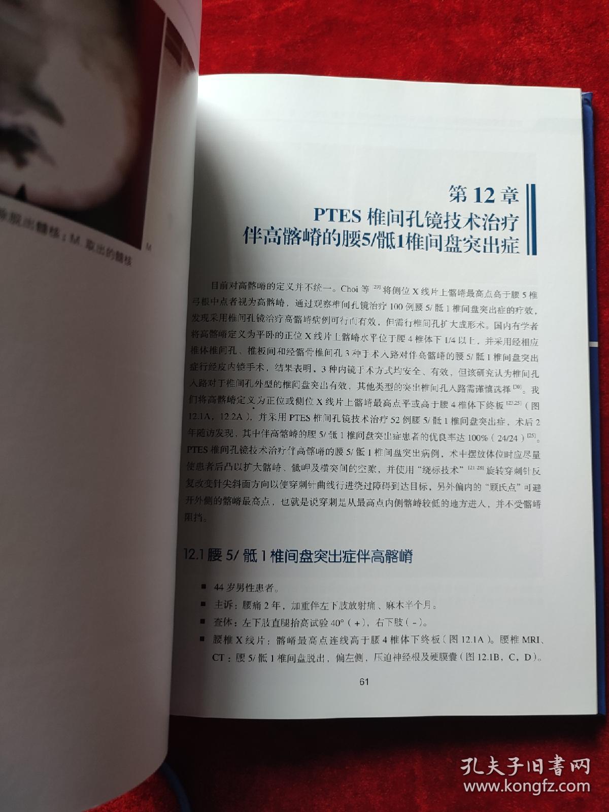 PTES椎间孔镜技术