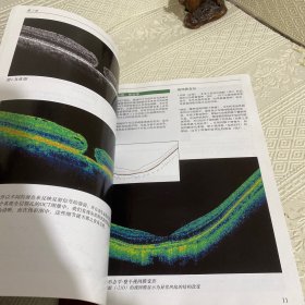 频域光相干断层扫描解读指南（献给资深眼科医生） 16开铜版彩印