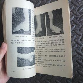 小儿麻痹后遗症穴位刺激结扎疗法