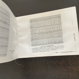 异常心电图图谱