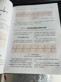 起搏心电图解析