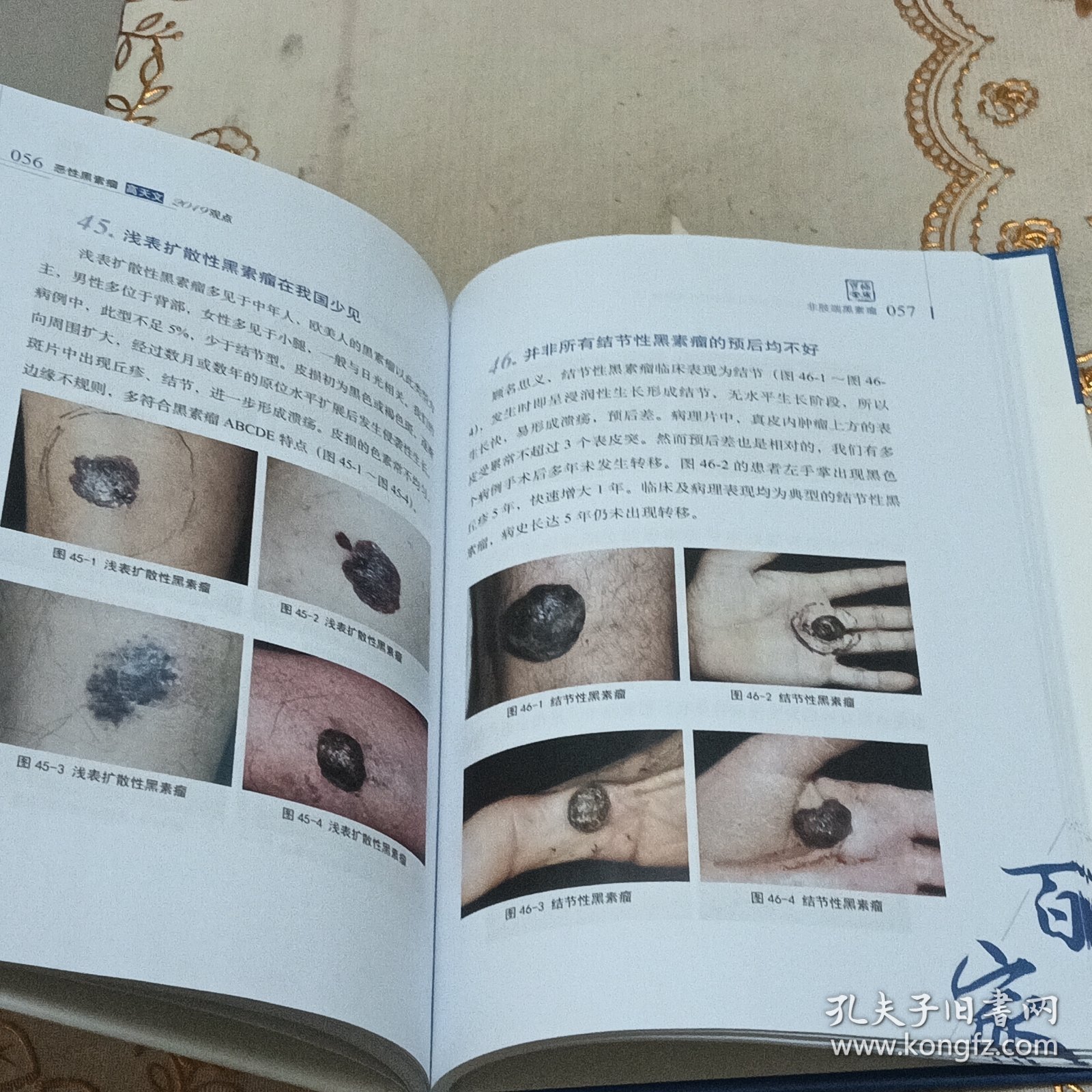 恶性黑素瘤高天文2019观点/中国医学临床百家