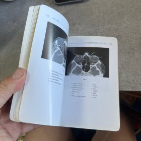 头和脑正常CT解剖袖珍图谱