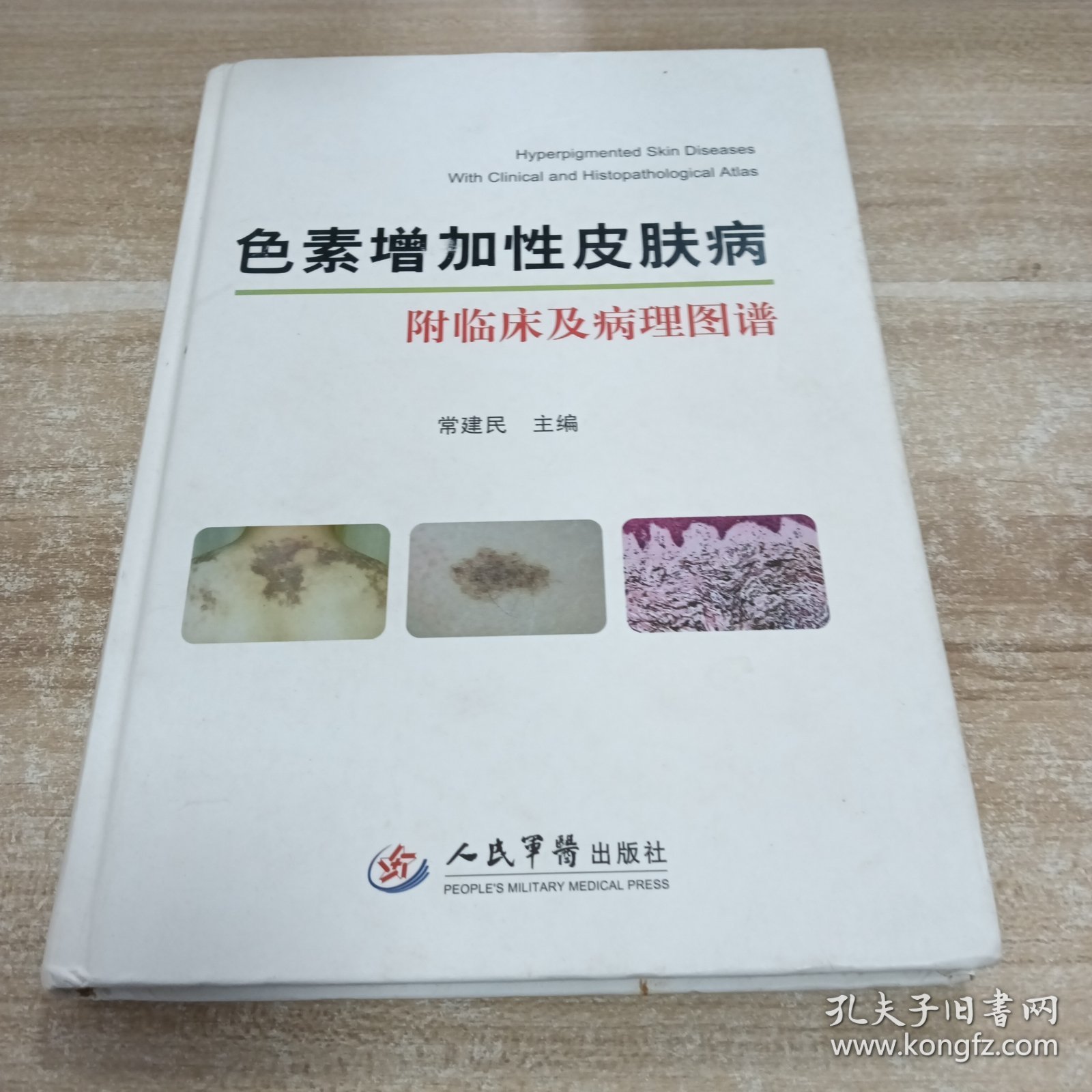 色素增加性皮肤病