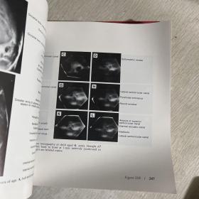 Normal Neuroradiology And Atlas of the Skull, Sinuses, and Facial Bones ，正常神经放射学 和颅骨（头骨）、鼻窦和面部骨骼图谱图集，大开本