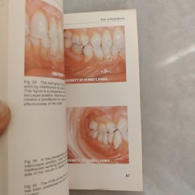 Occlusal Adjustment of the Natural Dentition（自然义齿的咬合调整）英文版