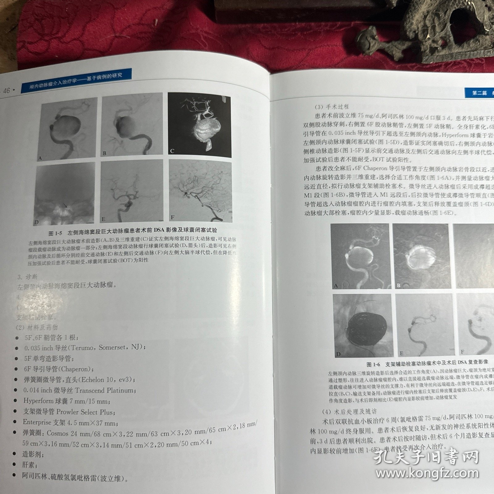 颅内动脉瘤介入治疗学：基于病例的研究